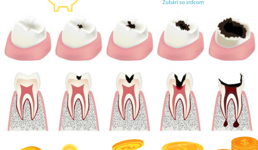 Ako ušetriť u zubára?