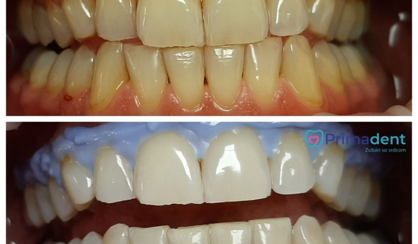 Bielenie zubov - Ako sa vyhnúť poškodeniu zubov?
