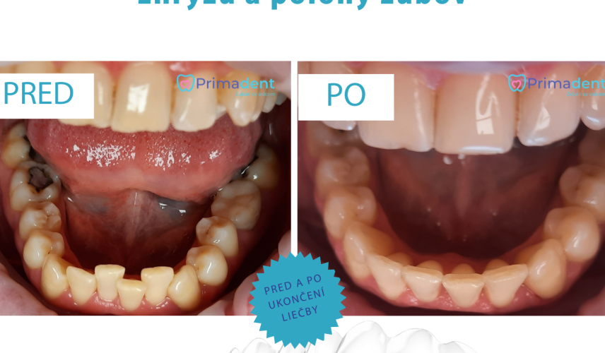 Priehľadný vyrovnávač - fotografie pred a po liečbe