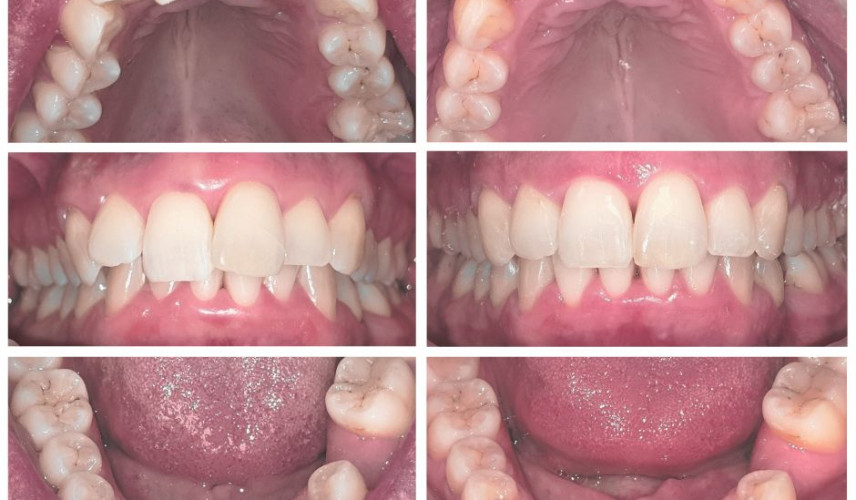 Priehľadný vyrovnávač - Ďalšia úspešná premena