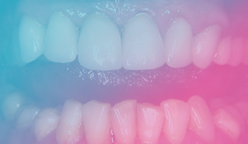 Estetické úpravy zubov