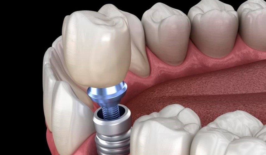 Čo robiť pred a po zavedení implantátu?