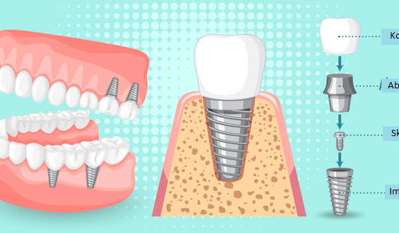 Zubné implantáty - najčastejšie otázky
